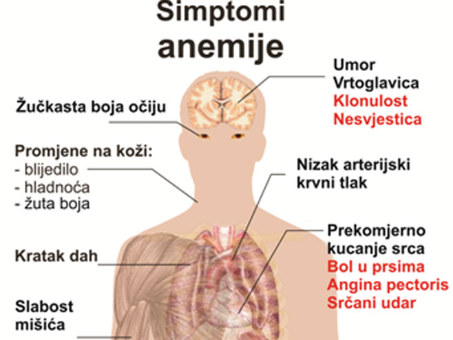 Simptomi anemije - 